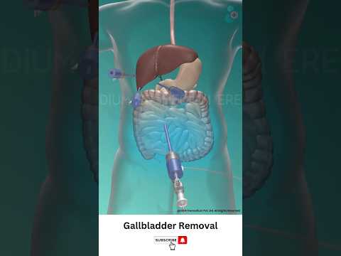 Gallbladder Removal Surgery ↪ 3D Medical Animation #Shorts #Gallbladder