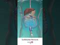 Gallbladder Removal Surgery ↪ 3D Medical Animation #Shorts #Gallbladder