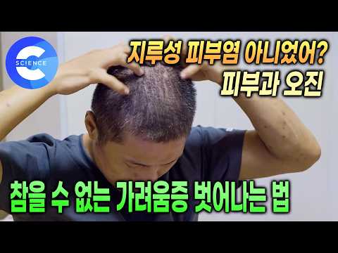 피부과 오진으로 5년 동안 잘못알고 있었던 두피질환 | 일상생활에 지장을 주는 심각한 두피질환, 치료 방법은 뭘까? | 올바른 샴푸 사용법 | 귀하신몸