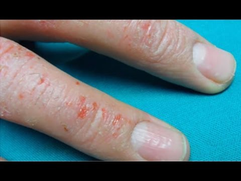 Los huesos las articulaciones la psoriasis Atopichesky la dermatitis y hlorka