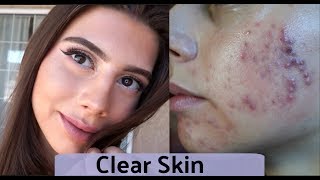 GET RID OF ACNE FAST: Clear Skin Update