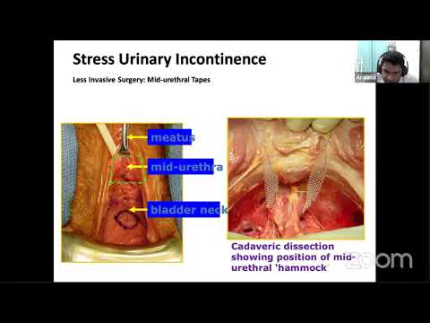 USI Smart Learning Program - 22nd December 2020 - Dr Arabind Panda - Stress Urinary Incontinence