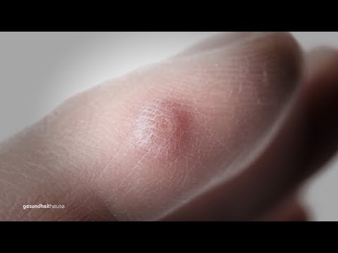 Warzen - Tipps vom Gesundheits-Coach