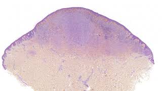 Deep Penetrating Nevus: rotating video clip of cases in the #NonAIpath program