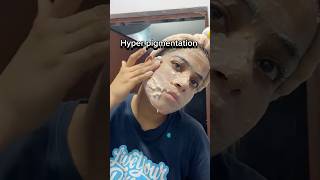 Download lagu Hyper pigmentation treatment #hyperpigmentation #skinglowup #skincare #glowingskin #hack #glowing mp3 Download lagu Hyper pigmentation treatment #hyperpigmentation #skinglowup #skincare #glowingskin #hack #glowing mp3