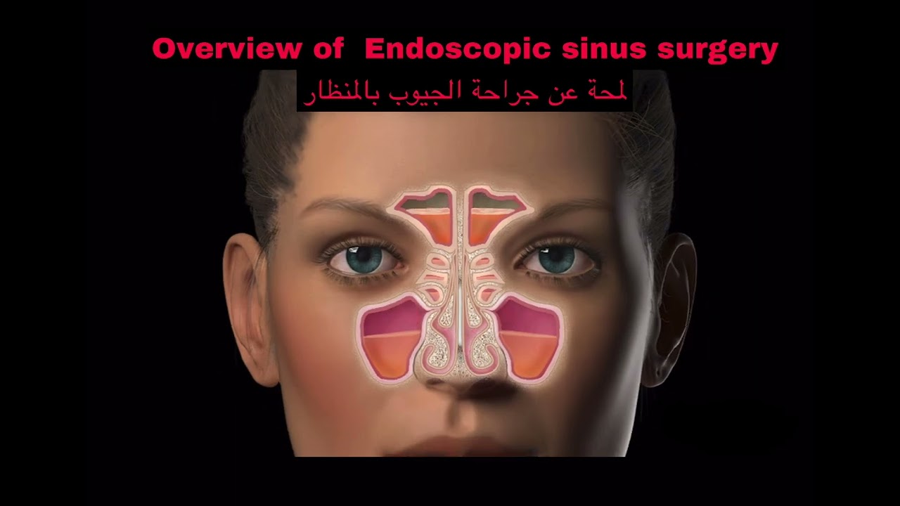Endoscopic sinus surgery جراحة الجيوب بالمنظار