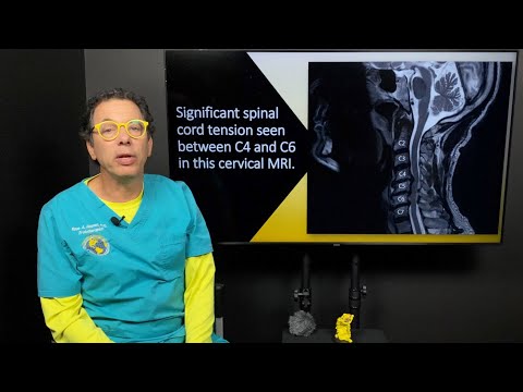 Internal tremors, whole body vibrations, & the connection to neck instability & spinal cord tension