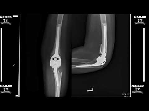 Distal Humerus Fracture Cases   What would you do?