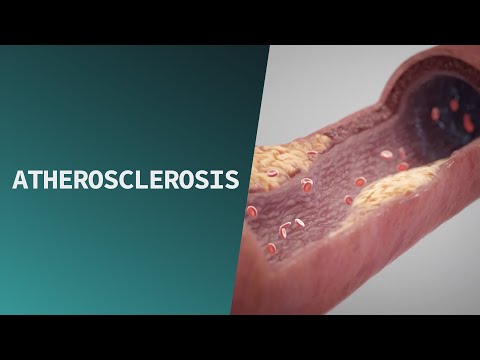 Atherosclerosis | Pathologies