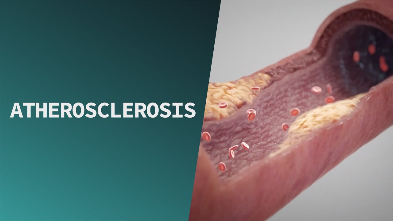 Atherosclerosis | Pathologies