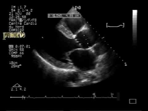 Aortic Valve Prolapse