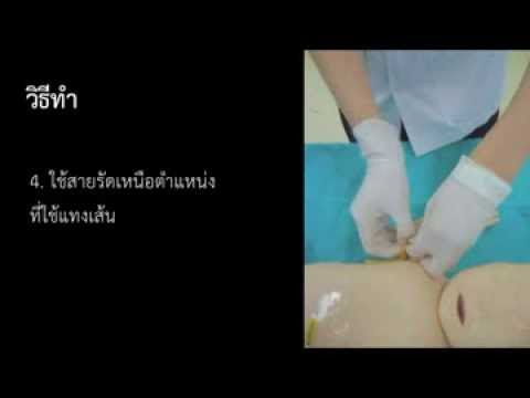 ครีมสำหรับเด็กจากโรคสะเก็ดเงิน ที่พวกเขารักษากลากใน Pyatigorsk