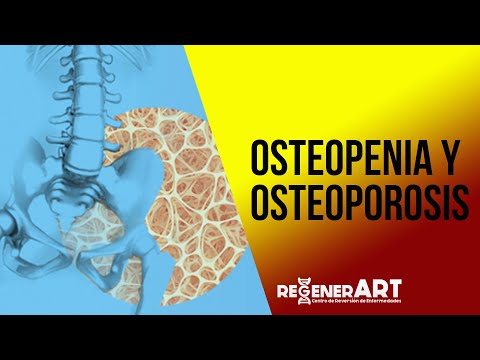 Artroza și osteoporoza articulației umărului