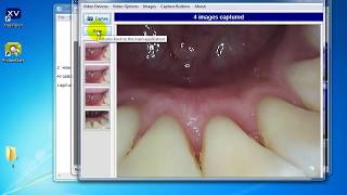 How to install ProDENT Intraoral camera and capture button software for Apteryx