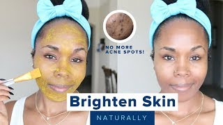How to Brighten Skin, Reduce Acne Scars, Hyperpigmentation & Discoloration | Home Remedies
