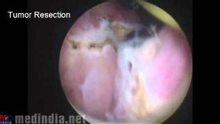 Trans Urethral Resection of Bladder Tumor (TUBRT)
