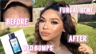 How to clear Tiny Red Bumps on your face | Fungal Acne Skin Care Routine