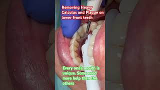 Removing Heavy Built-up of Calculus and Plaque on Lower Teeth #shortsfeed