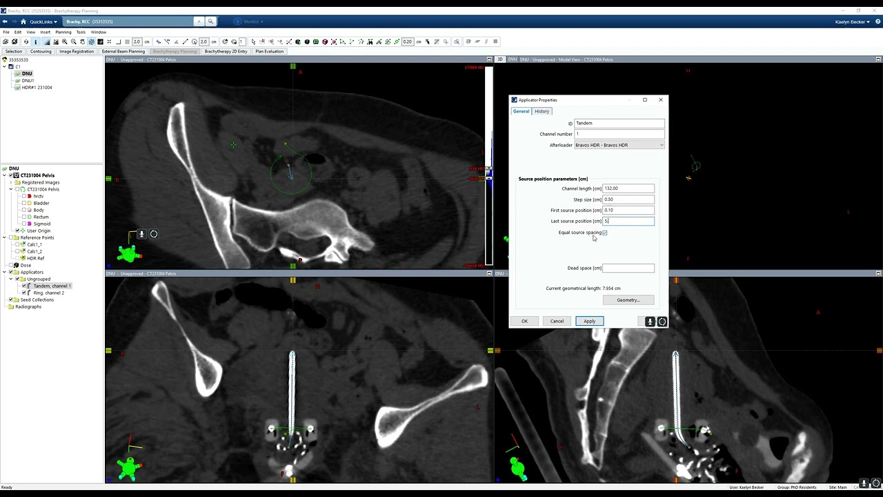 Brachytherapy Planning Part 3  Adding Dwell Positions to a Tandem