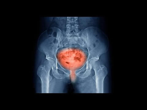 Prostatita inflamatorie asimptomatică