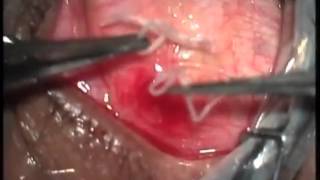 Removing A 19 CM Long Worm From Mans Eye