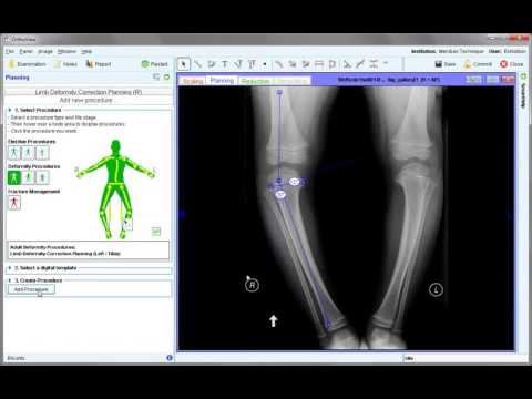 Other Deformity Wizards | Deformity Correction Planning | Materialise OrthoView