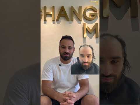 Hair Transplant in Egypt: Italy to Cairo Transformation! ??➡️?? #hairtransplantation