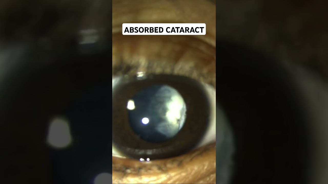 ABSORBED CATARACT