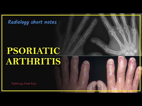 Térd artrózis hatékony gyógyszeres kezelés