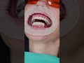 Dental Implant S All On 4 In Prague Shorts Dentist Dental Implant Veneers Short
