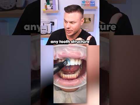 Reddit Veneers
