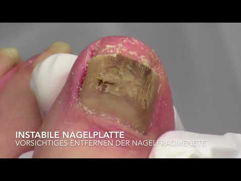 Wie viel Zeit dauert Operation an der Halswirbelsäule Wie zur Behandlung von Dysplasie TB Joint