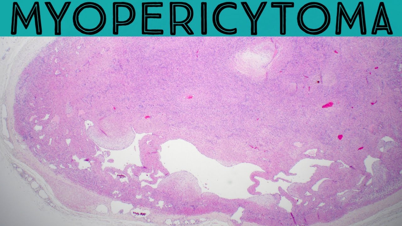 Myopericytoma vs Angioleiomyoma (pathology dermpath dermatology dermatopathology leiomyoma)