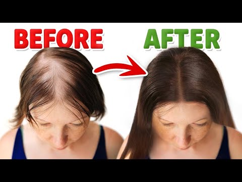 Shingles Natural Relief