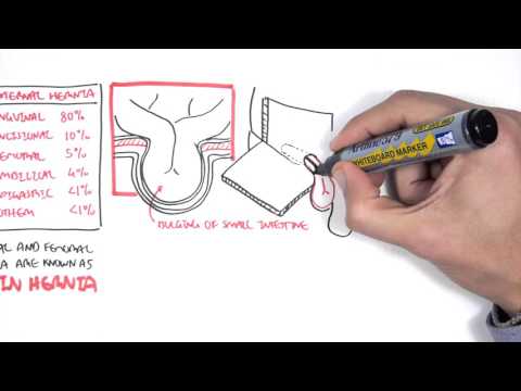 Introduction to Direct and Indirect Inguinal Hernia