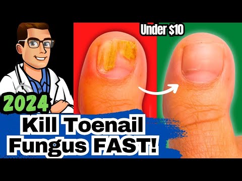 How to CURE Yellow Toenail Fungus Toe Fungus Remedies Treatment