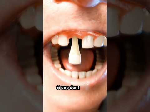 Que faire si une dent tombe 😳