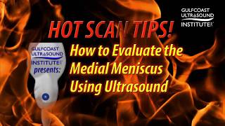 Hot Tip-How to Evaluate the Medial Meniscus Using Ultrasound