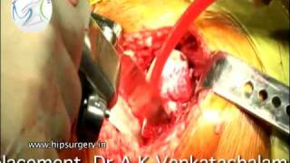 preview picture of video 'Total Hip replacement India - part 1'