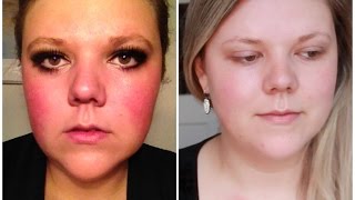 How I (Almost) Got Rid Of My Redness!