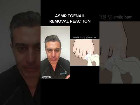 Fungal toe-nail removal