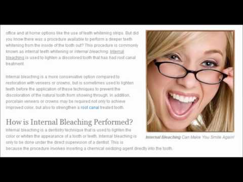 Internal Bleaching Teeth Whitening HD1:02