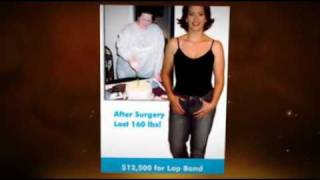 preview picture of video 'Surgery After Weight Loss'