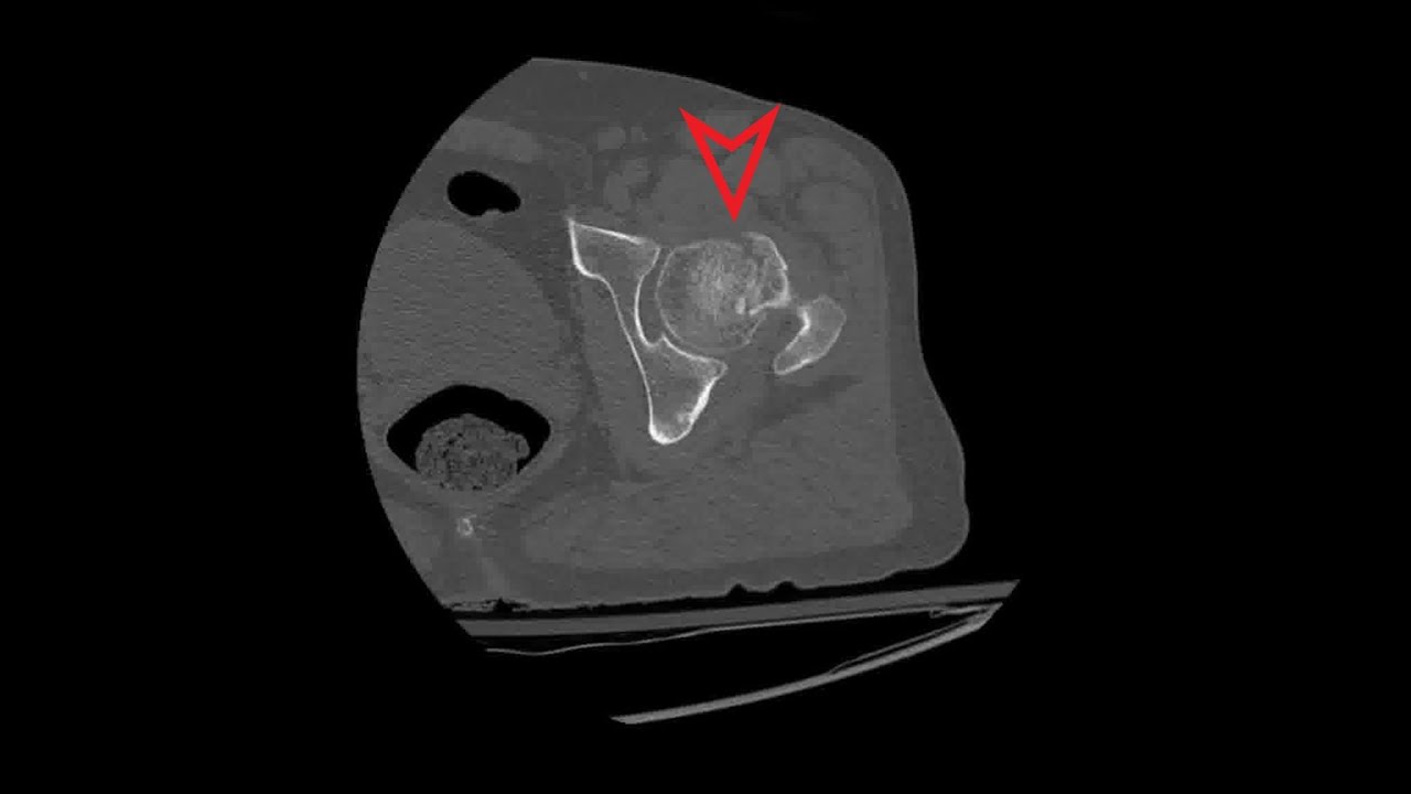 Hip CT: Subcapital Neck Fracture