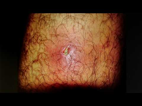 Die Öle für die Behandlung des Ekzems Die Prophylaxe bei der Schuppenflechte