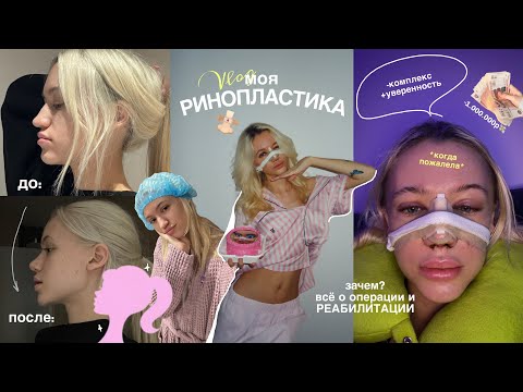 МОЯ РИНОПЛАСТИКА | всё о операции | результат и РЕАБИЛИТАЦИЯ 
