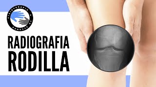 Dolor de rodilla, ¿cuando es necesaria una radiografia