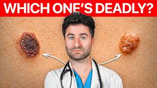 Melanoma or Mole? Here’s How YOU Can Tell The Difference