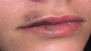 how to get rid of bruised lips from suction fast