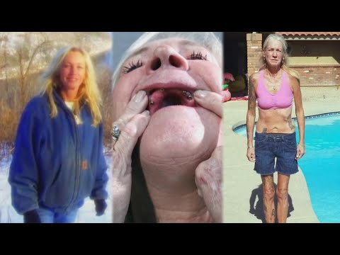 Millions reported problems with dental implants